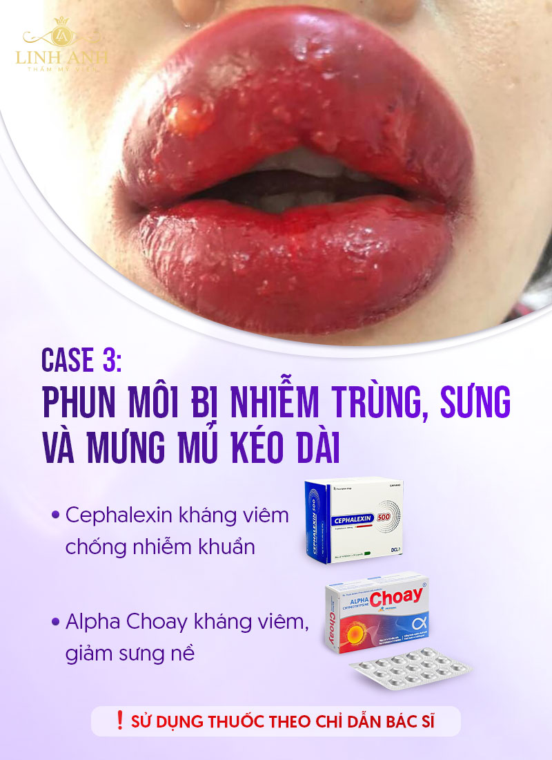 bôi thuốc gì nếu phun môi bị nhiễm trùng bôi thuốc gì nếu phun môi bị nhiễm trùng