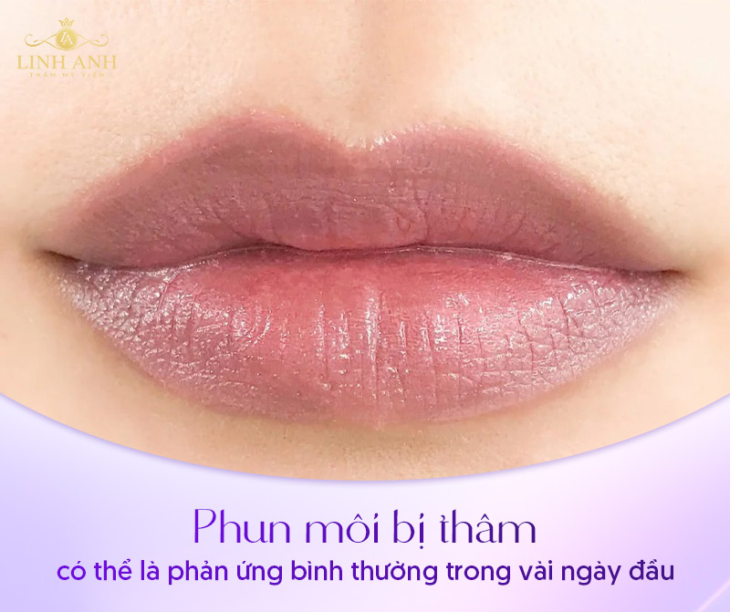 các trường hợp thâm môi sau phun các trường hợp thâm môi sau phun