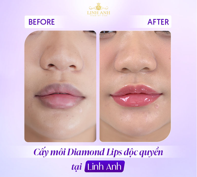 cách khắc phục phun môi xong bị khô cách khắc phục phun môi xong bị khô