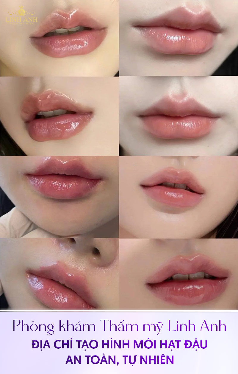 cách sở hữu môi hạt đậu cách sở hữu môi hạt đậu