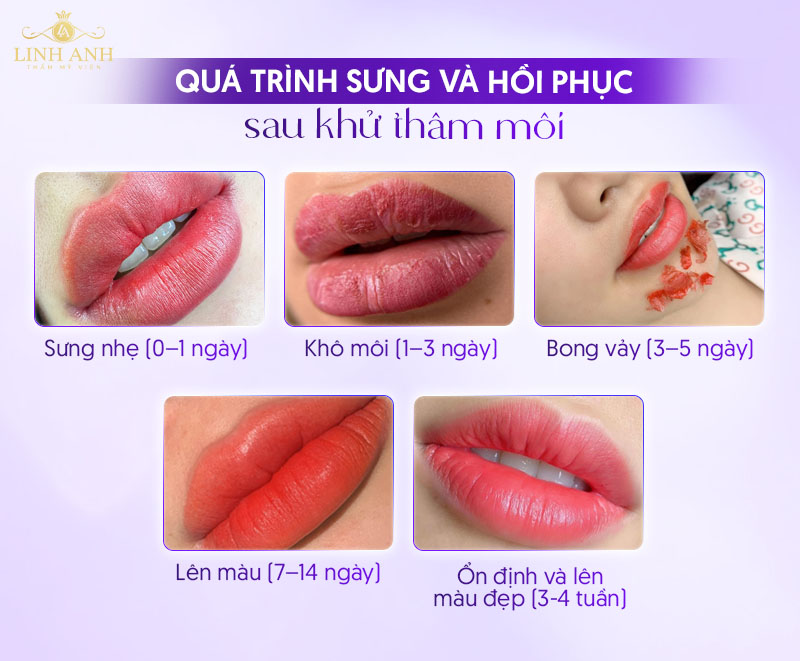 có đau không khi khử thâm môi
