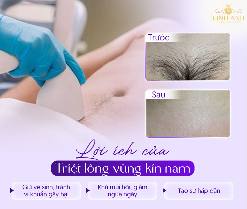 Có nên triệt lông vùng kín cho nam