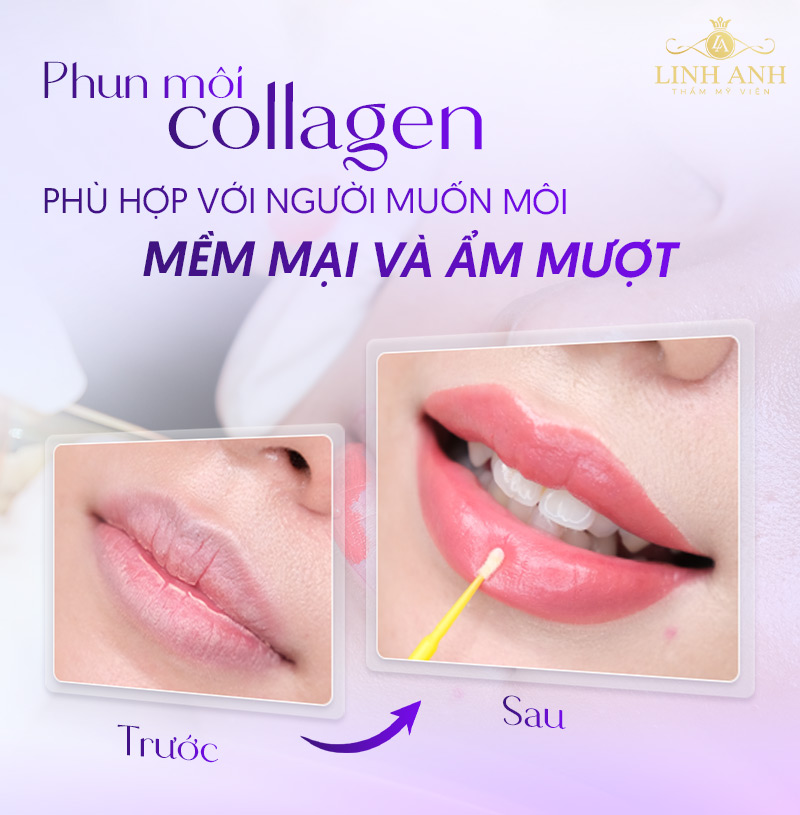 có nên xăm môi collagen không có nên xăm môi collagen không