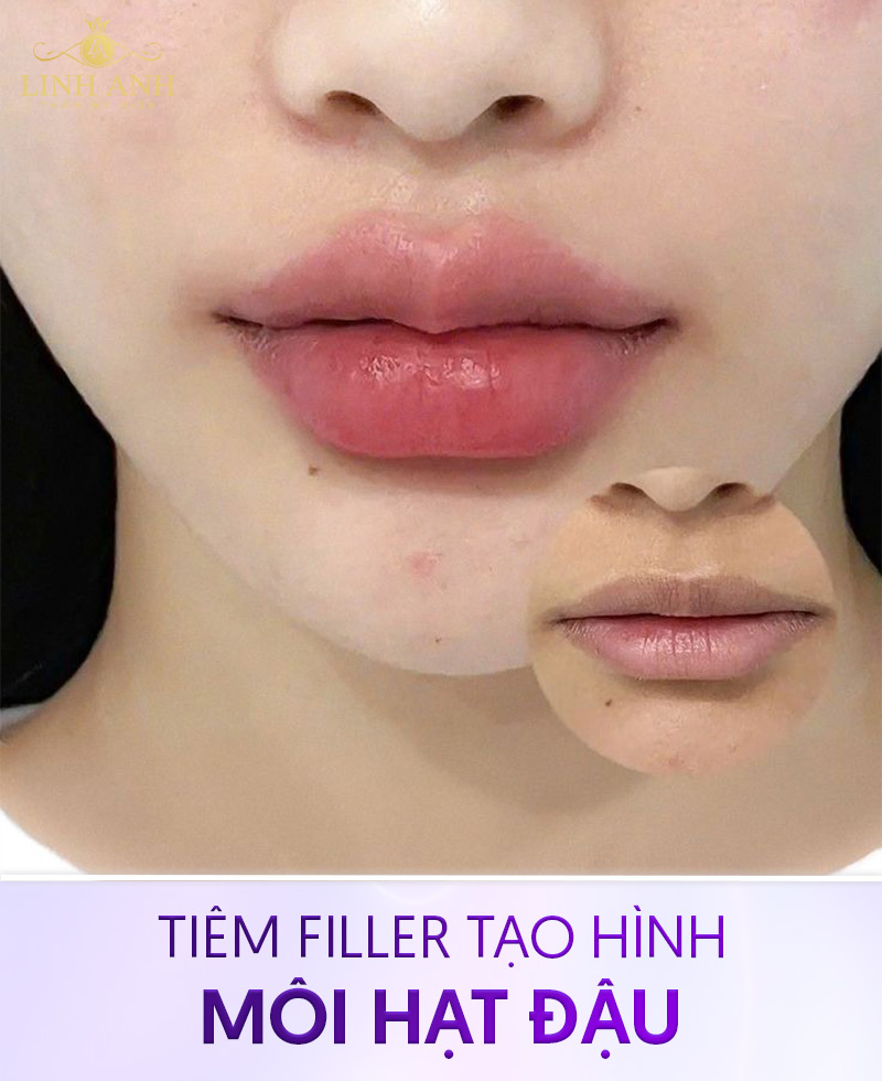 đặc điểm môi hạt đậu đặc điểm môi hạt đậu