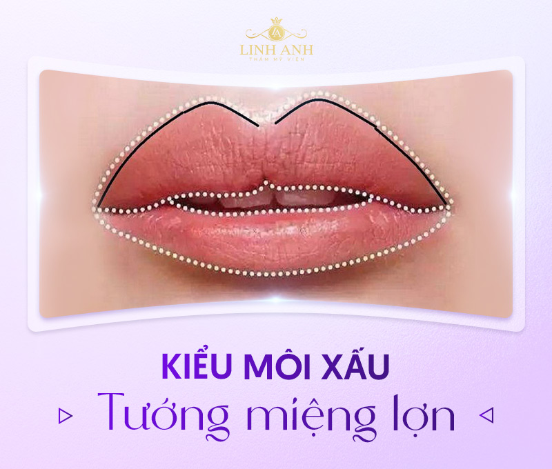 dáng môi xấu cần khắc phục dáng môi xấu cần khắc phục