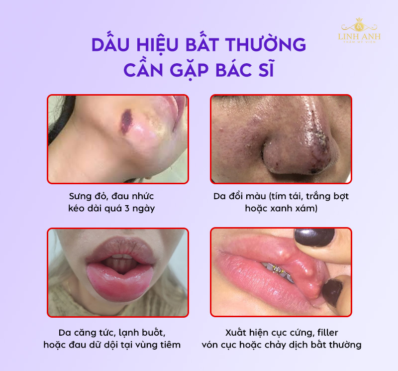 Dấu hiệu sau tiêm filler bất thường