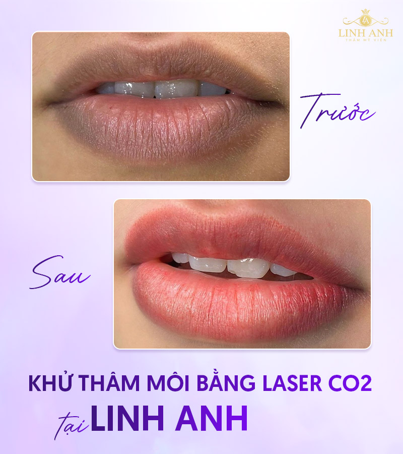 Hình ảnh Khử thâm môi bằng Laser CO2 Fractional