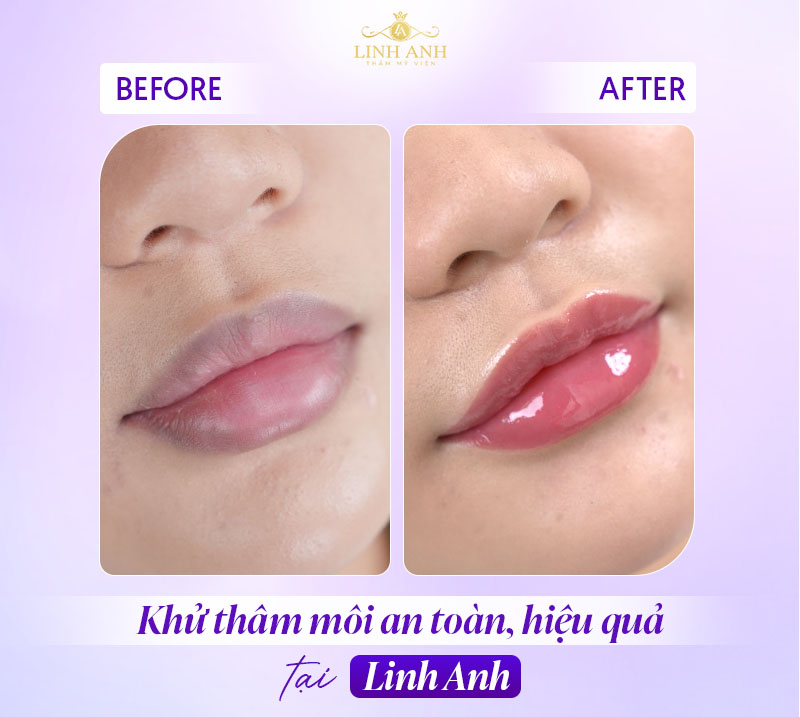 Hình ảnh khử thâm môi Hình ảnh khử thâm môi