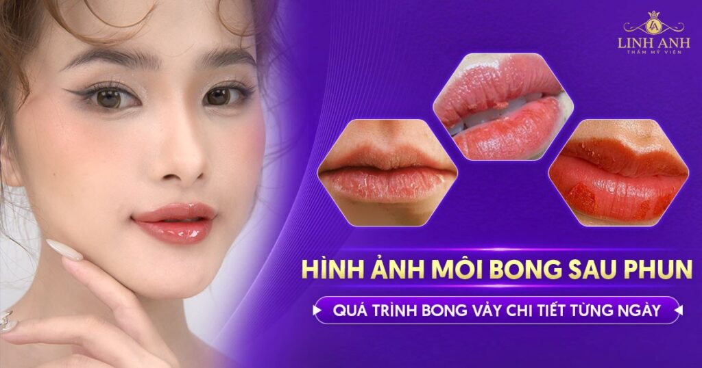 hình ảnh môi đang bong sau phun