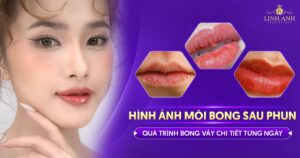 hình ảnh môi đang bong sau phun