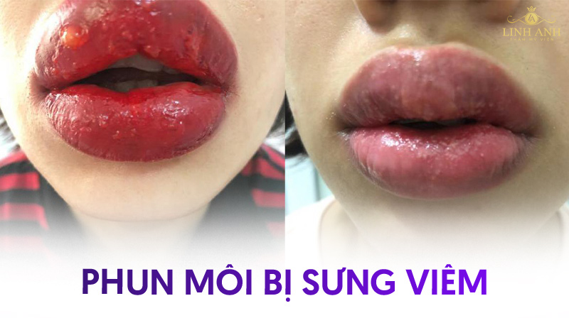 hình ảnh phun môi bị lỗi