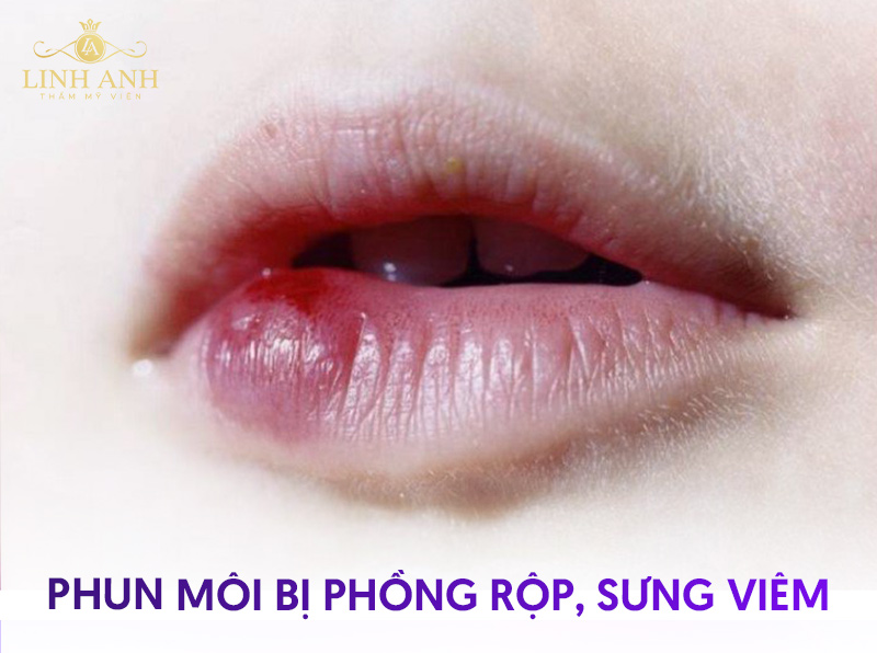 hình ảnh phun môi hỏng