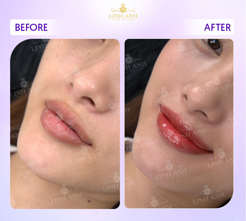 hình ảnh phun môi hot trend hình ảnh phun môi hot trend