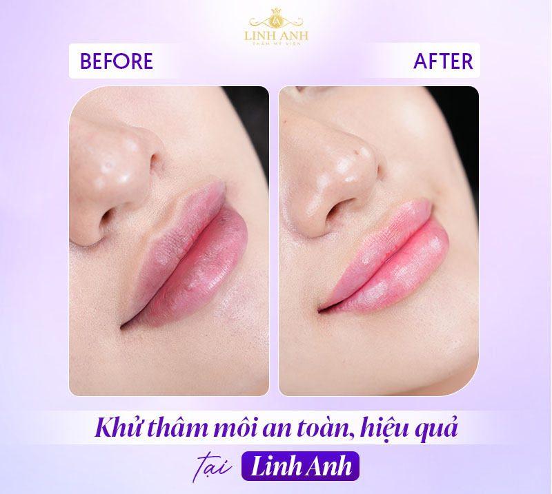 Hình ảnh sau khi khử thâm môi Hình ảnh sau khi khử thâm môi
