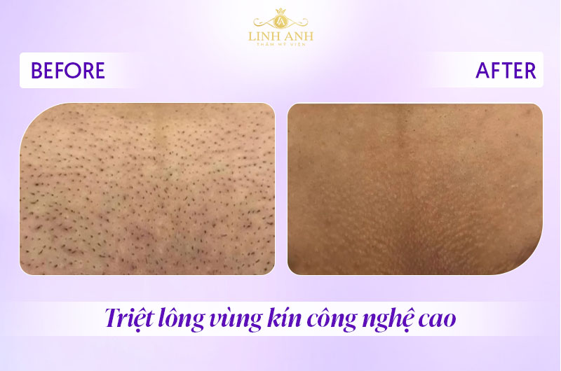 Hình ảnh sau khi triệt lông bikini