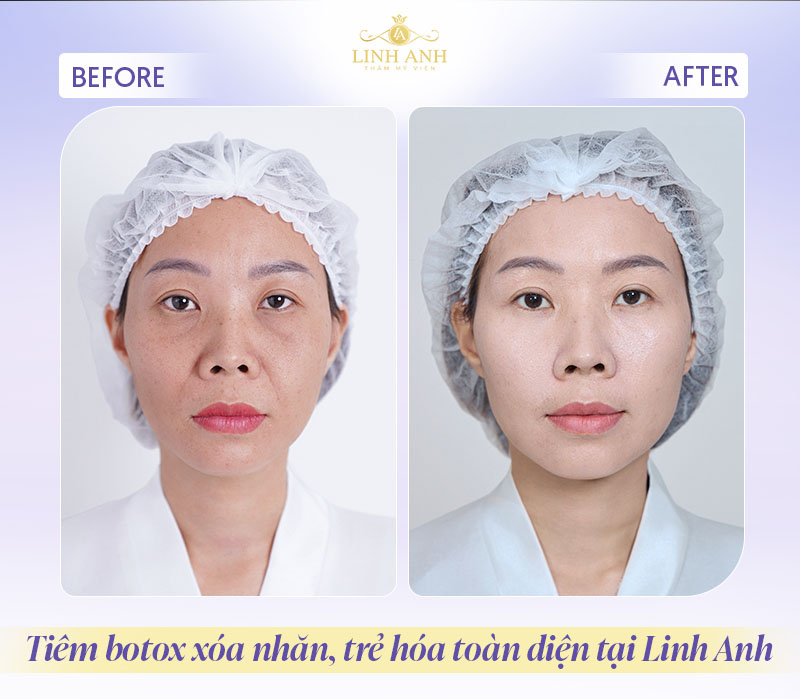 Hình ảnh sau tiêm botox trẻ hóa