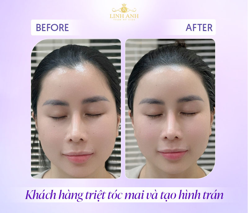 triệt tóc mai vùng trán Hình ảnh triệt đường chân tóc