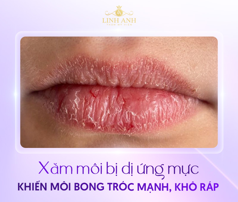 hình ảnh xăm môi bị hỏng