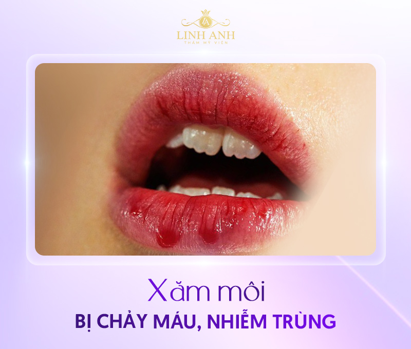 hình ảnh xăm môi bị lỗi