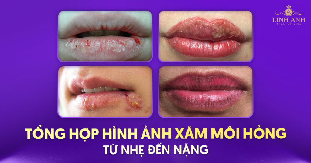 hình ảnh xăm môi hỏng