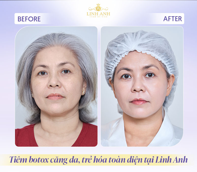 Hình ảnh xóa nhăn bằng Botox