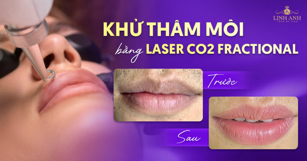 Khử thâm môi bằng Laser CO2 Fractional