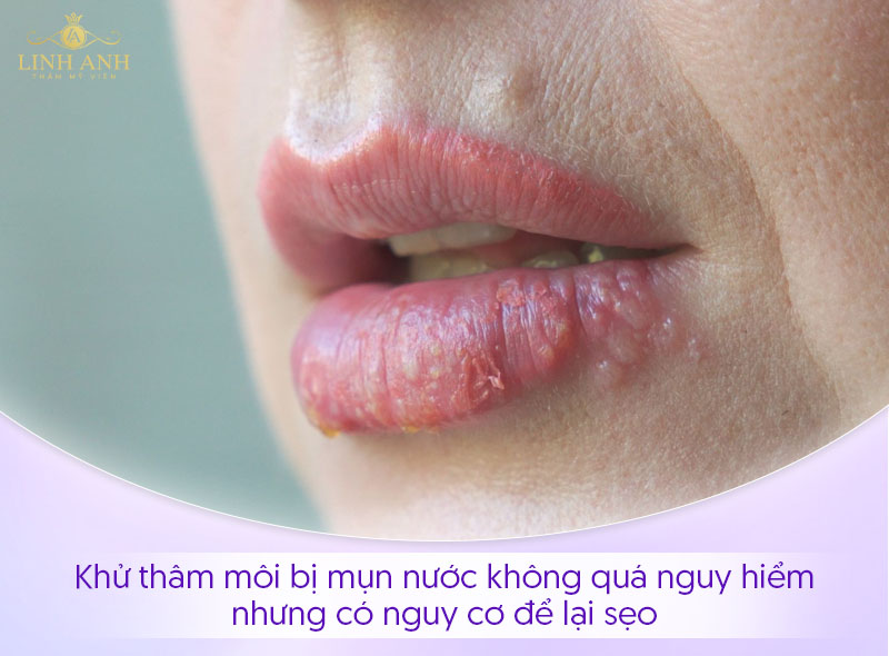 Khử thâm môi bị nổi mụn nước có sao không Khử thâm môi bị nổi mụn nước có sao không