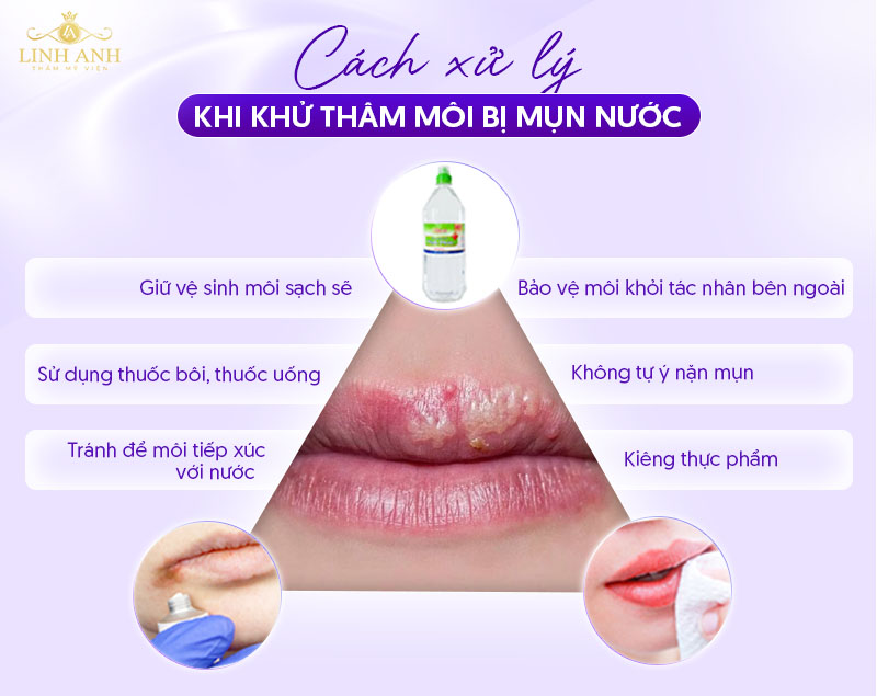 Khử thâm môi bị nổi mụn nước phải làm sao