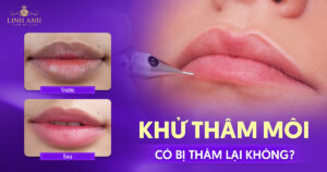 khử thâm môi có bị thâm lại không