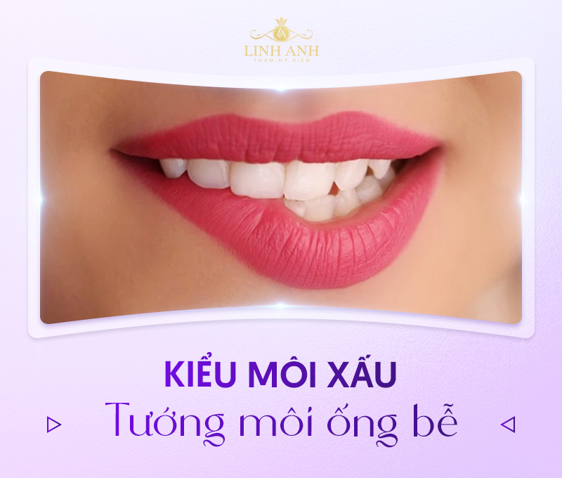 khuôn môi xấu khuôn môi xấu