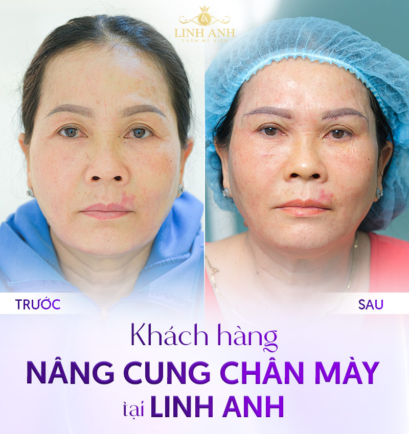 mày sau khi nâng cung bao lâu thì hết sẹo mày sau khi nâng cung bao lâu thì hết sẹo