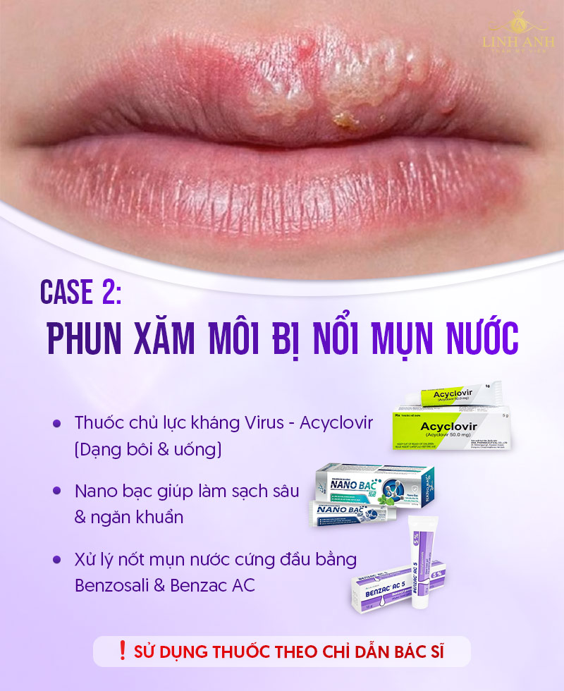 môi bị nhiễm trùng sau phun xăm bôi thuốc gì môi bị nhiễm trùng sau phun xăm bôi thuốc gì
