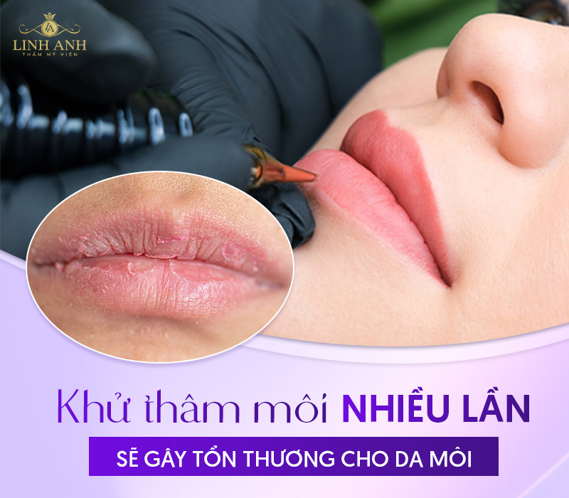 môi khử thâm xong có thâm lại không