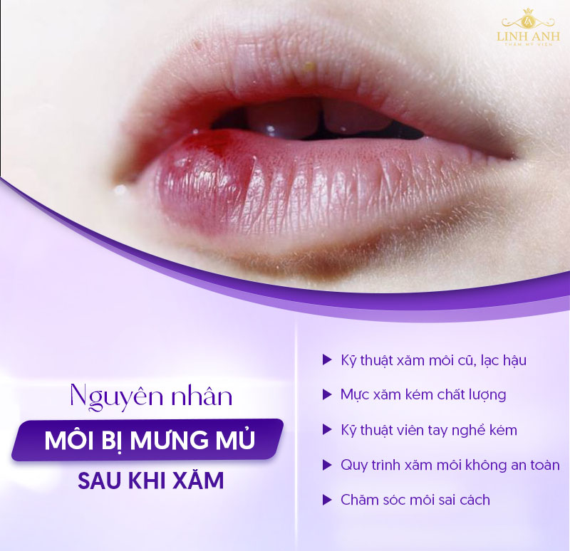 môi mưng mủ sau xăm nên bôi thuốc gì