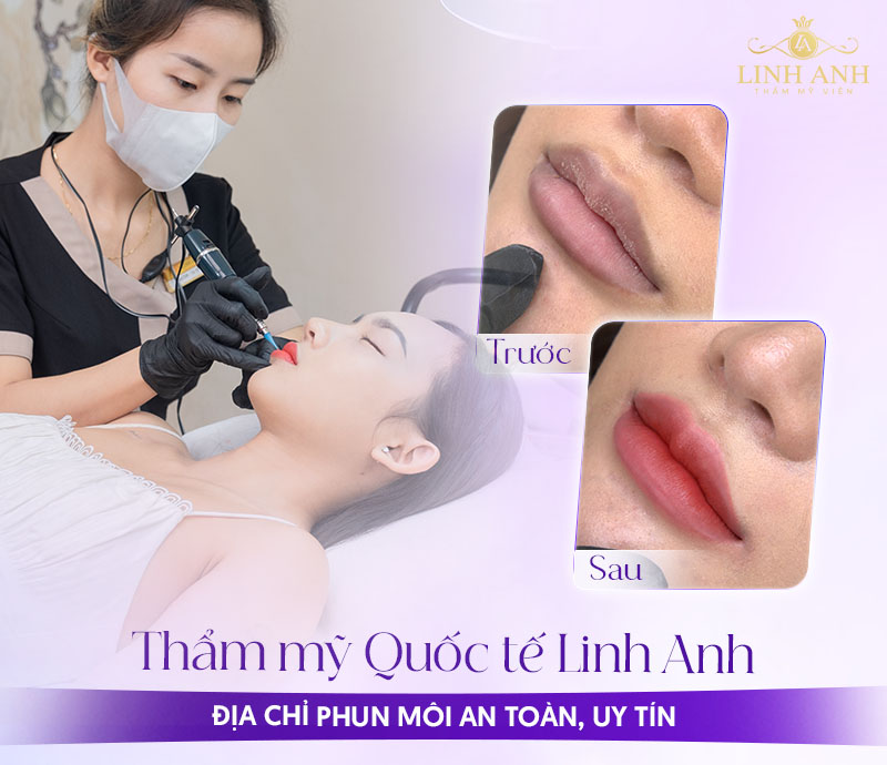 môi sau xăm bị mưng mủ nên bôi thuốc gì