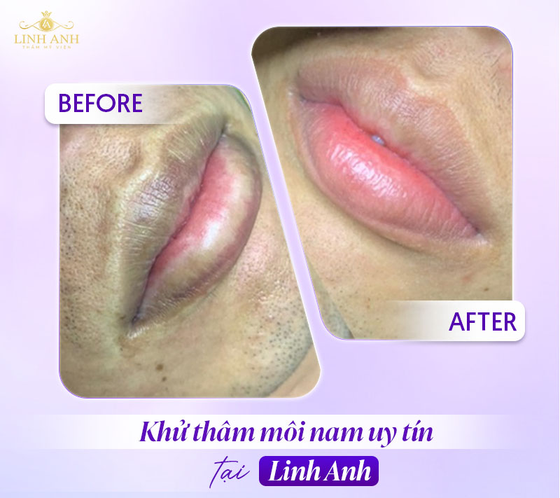 môi thâm ở nam do đâu môi thâm ở nam do đâu