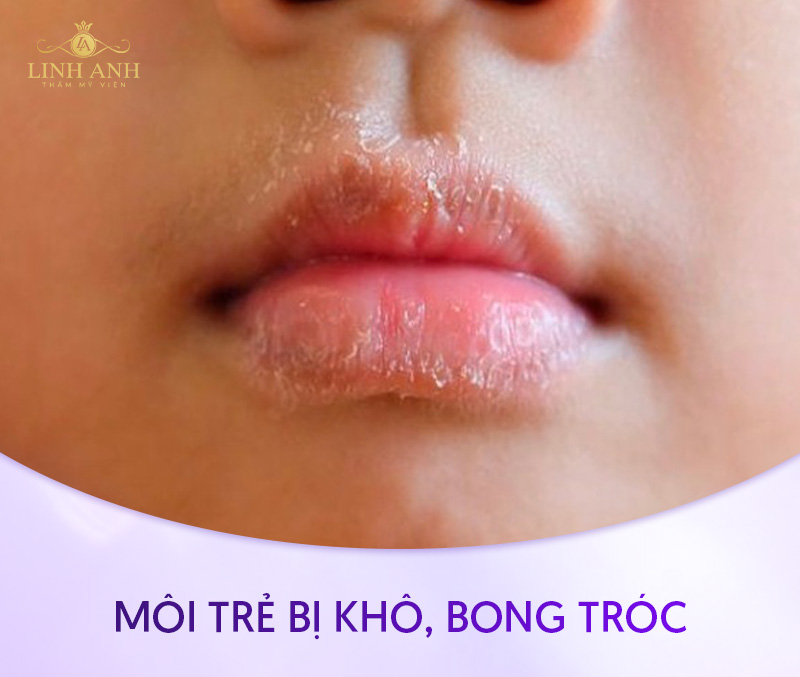 môi trẻ bị thâm do đâu môi trẻ bị thâm do đâu