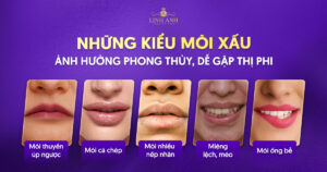 môi xấu