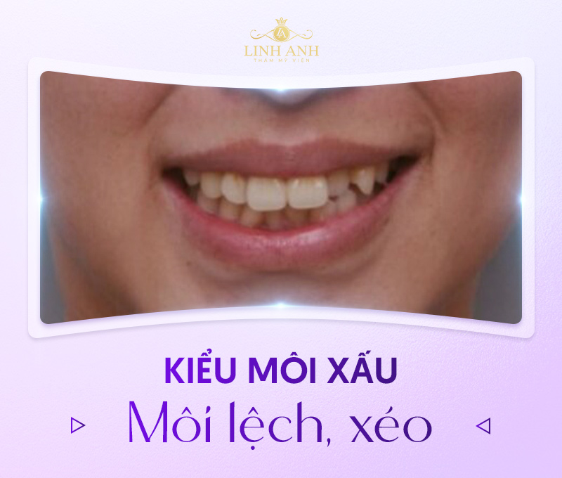 môi xấu là dáng môi như thế nào môi xấu là dáng môi như thế nào