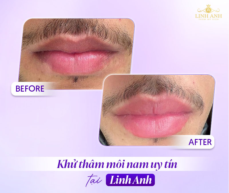 môi xỉn màu ở nam do đâu môi xỉn màu ở nam do đâu