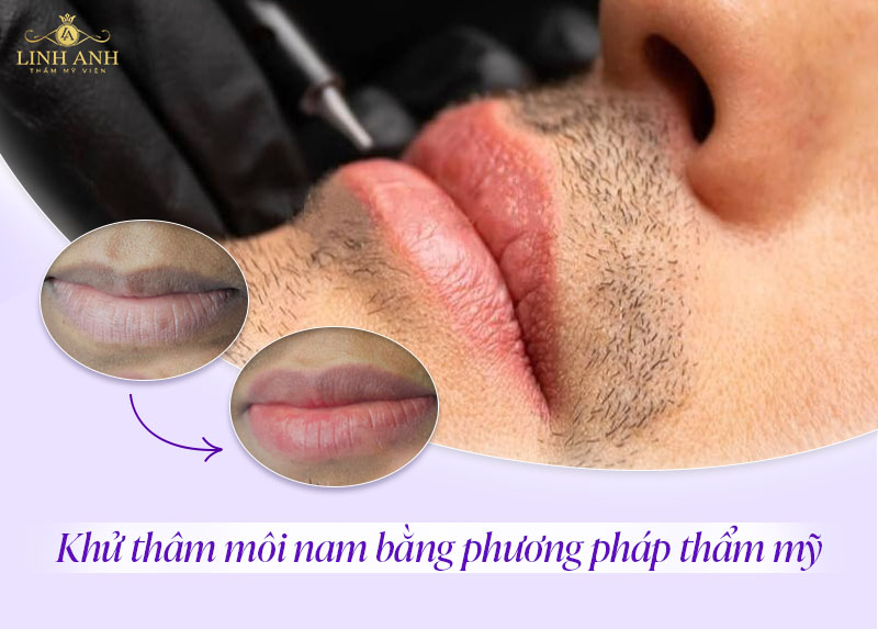 nguyên nhân môi thâm ở nam nguyên nhân môi thâm ở nam