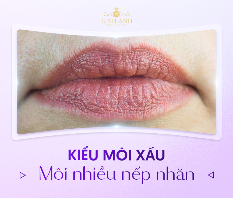 những dáng môi xấu cần cải thiện những dáng môi xấu cần cải thiện