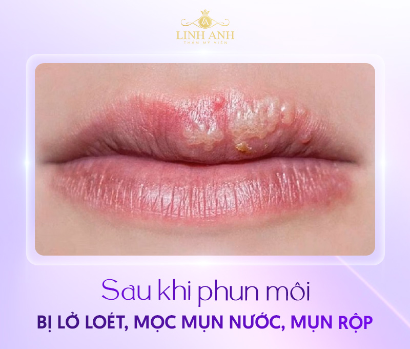 những hình ảnh xăm môi bị hỏng