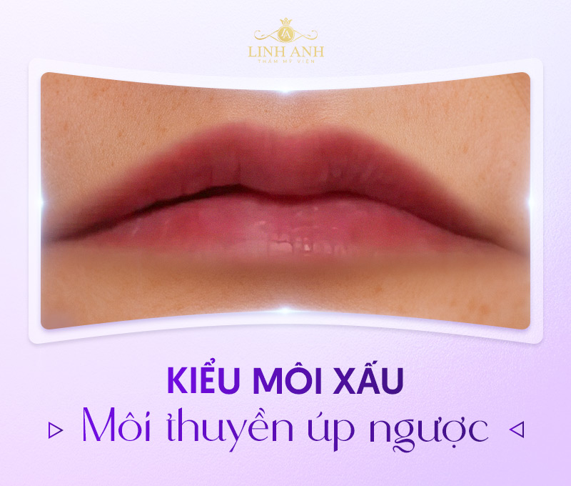 những kiểu môi xấu những kiểu môi xấu