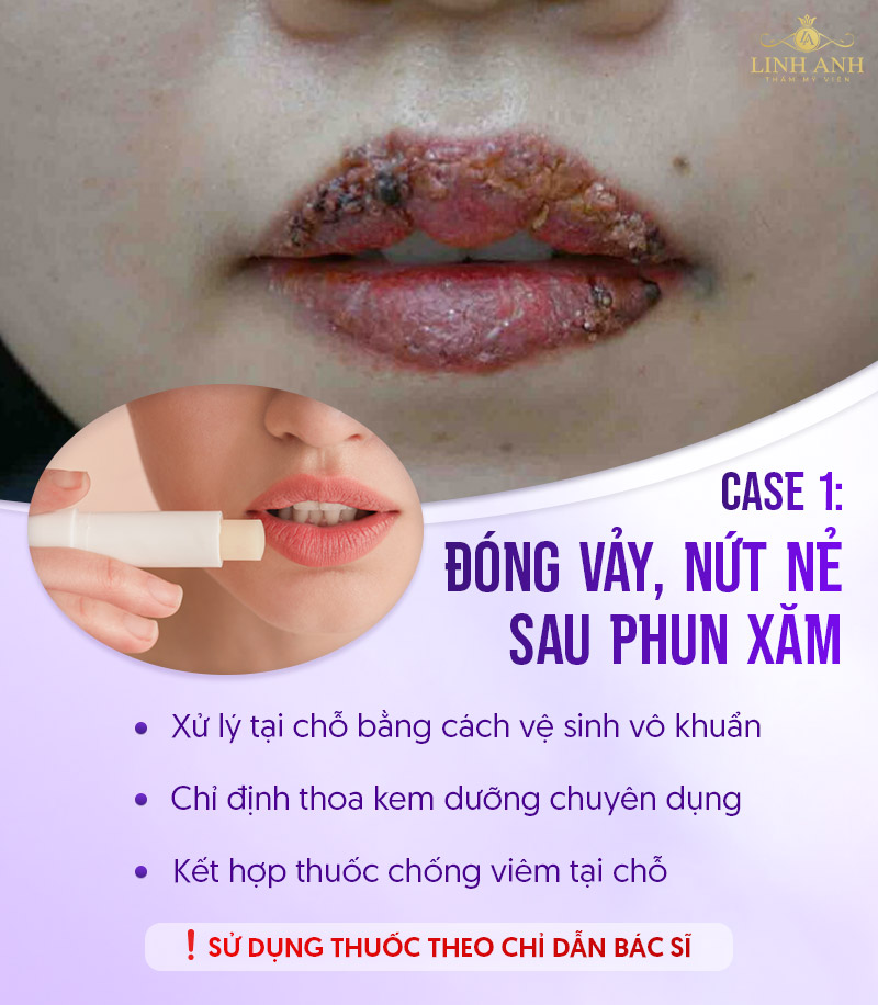 phun môi bị nhiễm trùng bôi thuốc gì phun môi bị nhiễm trùng bôi thuốc gì