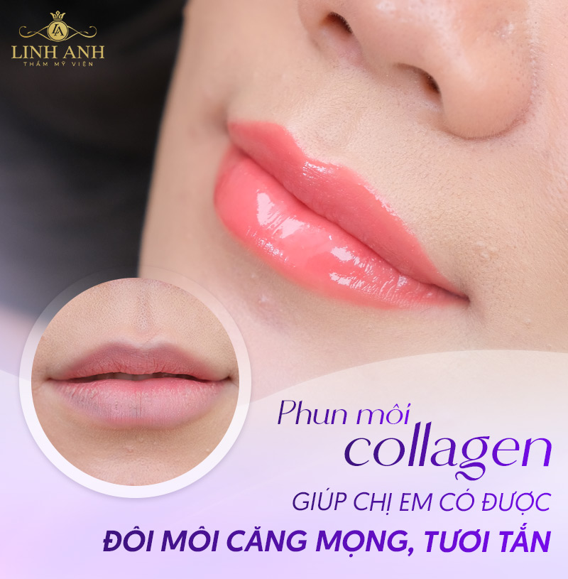 phun môi collagen có nên không phun môi collagen có nên không