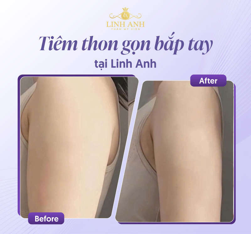 Review tiêm botox bắp tay