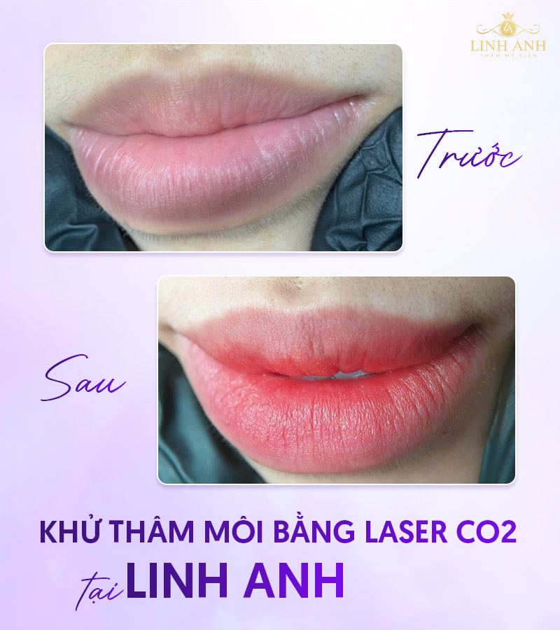 Sau Khử thâm môi bằng Laser CO2 Fractional