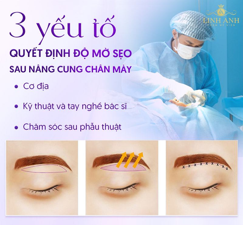 sẹo bao lâu thì hết sau khi nâng cung mày sẹo bao lâu thì hết sau khi nâng cung mày