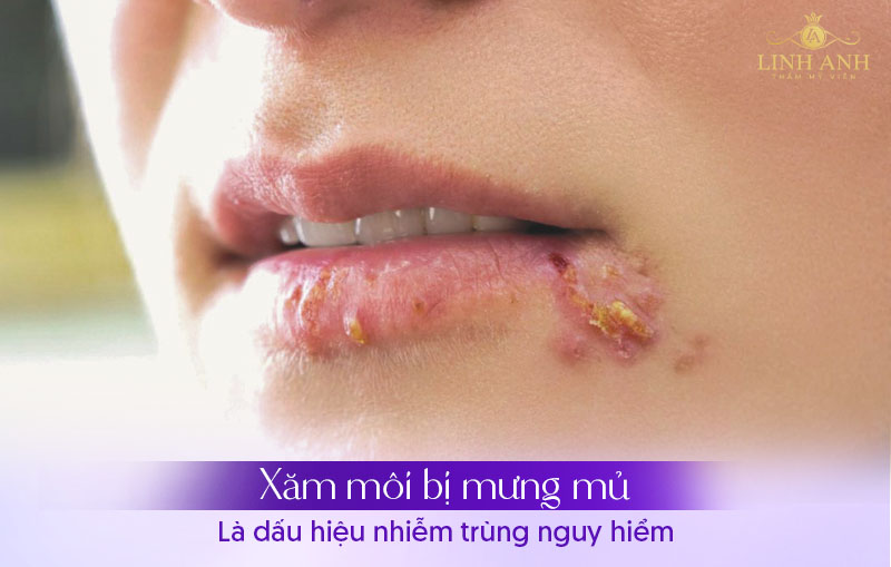 thuốc dùng để bôi khi xăm môi bị mưng mủ